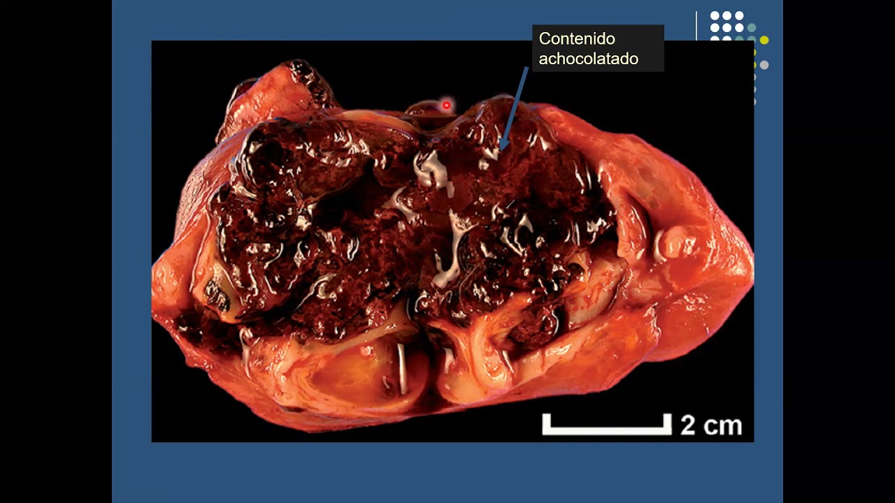 Patologia anexial uterina
