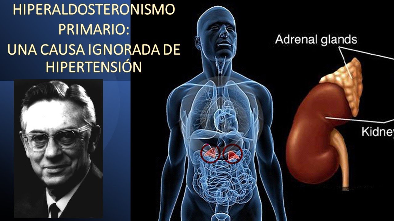 Hiperaldosteronismo primario: una causa ignorada de hipertensión arterial